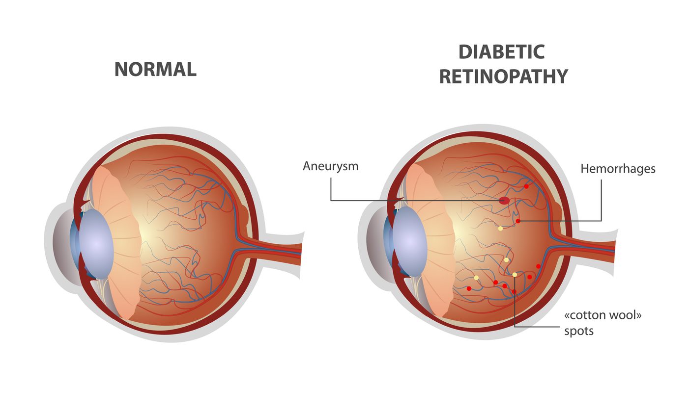 How diabetes affects the retina