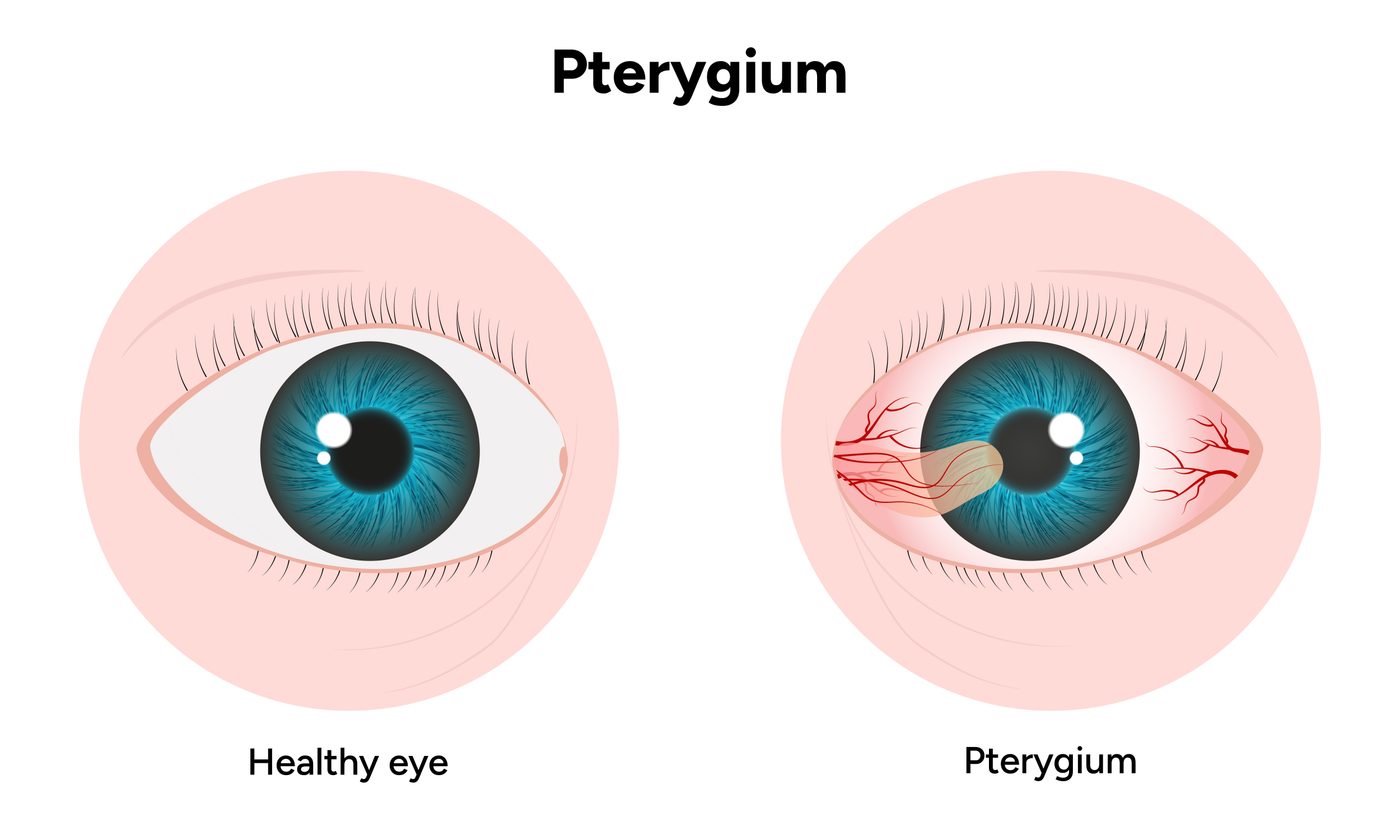 Pterygium eye growth treatment Repalle